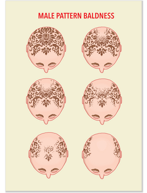 546 Male Pattern Baldness